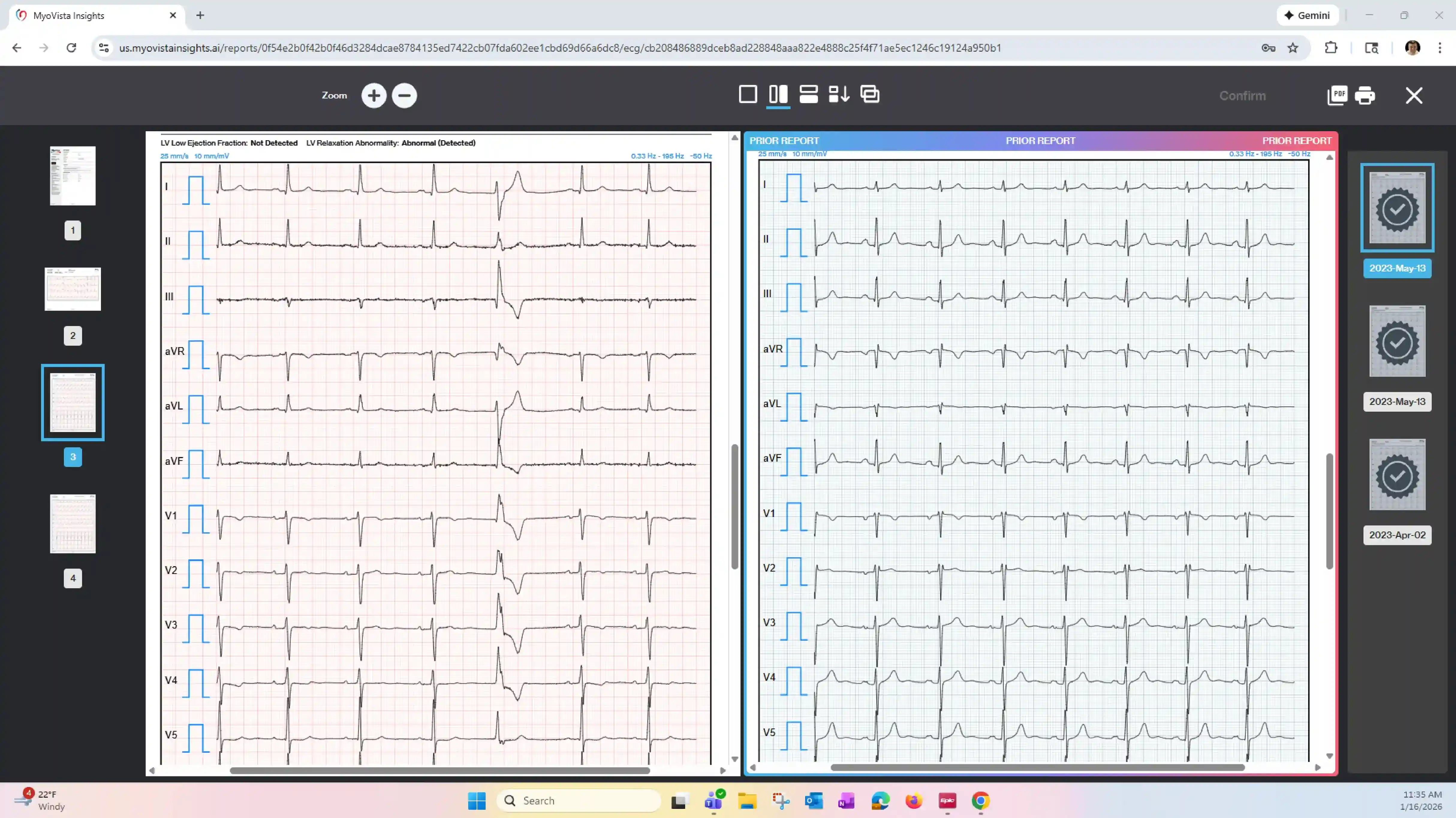 MyoVista Insights dashboard showing AI-ECG analysis